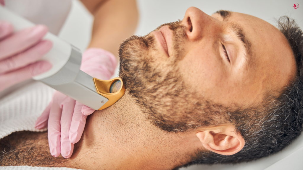 Laser Beard Removal for men