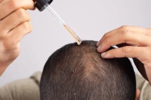 Man applying minoxadil to scalp