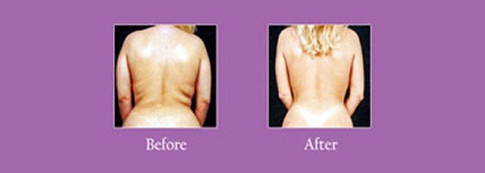 vaser before and after